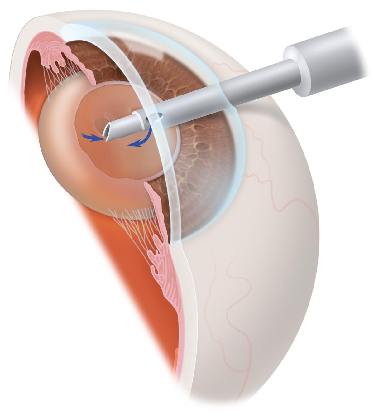 Оперативное лечение катаракты. Катаракта факоэмульсификация. Факоэмульсификация катаракты с имплантацией ИОЛ. Катаракта имплантация ИОЛ. Лазерная экстракция катаракты.